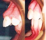 矯正歯科２段階治療前後のかみ合わせの変化