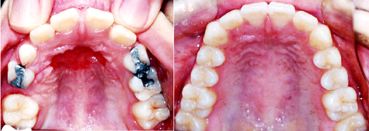 矯正歯科2段階治療により乳歯2本分の隙間に3本の永久歯が並んだアメリカからの転医症例