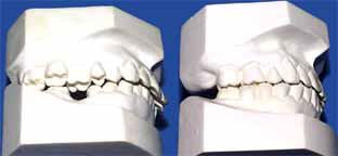 矯正歯科/すれちがい咬合の成人矯正歯科治療前後の歯ならびかみ合わせの変化