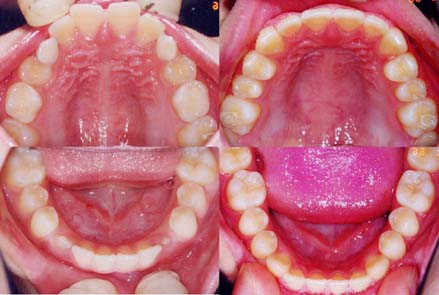 矯正歯科/予防歯科のコラボレ−ションによってきれいな歯ならび/正しいかみ合わせになってしかもムシ歯が1本もない患者さん