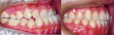 矯正歯科/予防歯科のコラボレ−ションによってきれいな歯ならび/正しいかみ合わせになってしかもムシ歯が1本もない患者さん/非抜歯で骨格性の下顎前突（受け口）を矯正歯科治療
