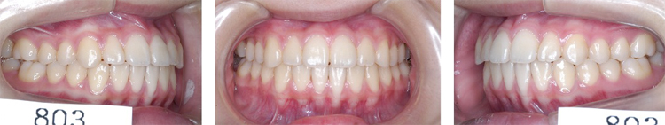 「ハリウッドスマイル7症例めの矯正歯科治療術後の歯列」
