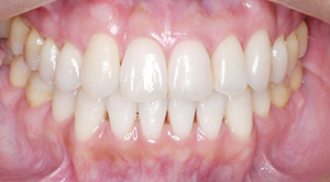 「成人矯正歯科症例4)」の鎌倉 dentfaco 予防歯科での先進医療による純白の材料で修復・ホワイトニング後の写真