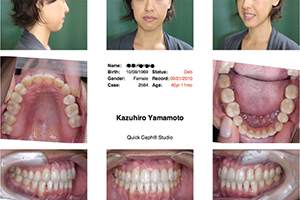 「矯正歯科治療前歯部に反対咬合を伴う叢生・右側側切歯欠損の矯正歯科専門医による矯正歯科治療結果」