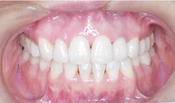 成人矯正歯科症例4)」の鎌倉 dentfaco 予防歯科での先進医療による純白の材料で修復・ホワイトニング後の写真