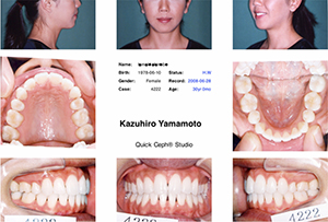 「成人矯正歯科症例」の鎌倉 dentfaco 予防歯科でのホワイトニング後の写真