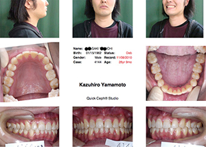 「ハリウッドスマイル8症例めの矯正歯科治療後の写真」