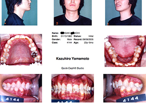 「ハリウッドスマイル8症例めの矯正歯科治療前の写真」