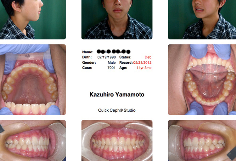「ハリウッドスマイル13症例めの矯正歯科治療後の写真」