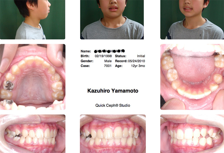 「ハリウッドスマイル13症例めの矯正歯科治療前の写真」