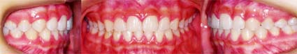矯正歯科/予防歯科のコラボレ−ションによってきれいな歯ならび/正しいかみ合わせになってしかもムシ歯が1本もない患者さんの非抜歯で矯正歯科治療した矯正歯科治療前後