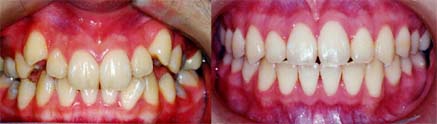 矯正歯科/予防歯科のコラボレ−ションによってきれいな歯ならび/正しいかみ合わせになってしかもムシ歯が1本もない患者さんの矯正歯科治療前後
