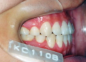 矯正歯科長期安定症例 矯正歯科動的治療終了時写真