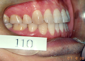 矯正歯科症例 矯正歯科治療後 長期安定症例