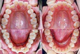八重歯/がたがた/デコボコした悪い歯並びの矯正歯科治療例